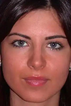 $rhinoplasty-12.webp