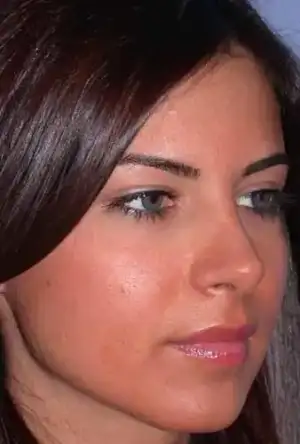 $rhinoplasty-16.webp