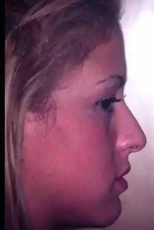 $rhinoplasty-3.webp