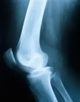 $osteoporoz.webp