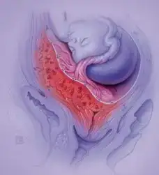 $placenta-previa.webp