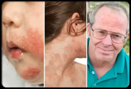 $-eczema.webp