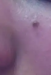 $sol yanak Ã¶nce.webp