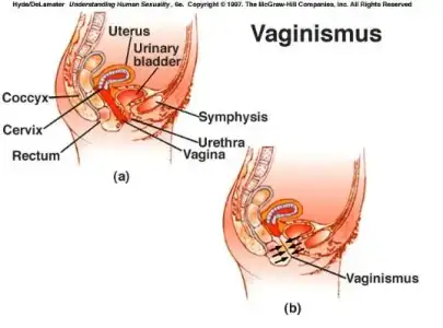 $vaginismus.webp