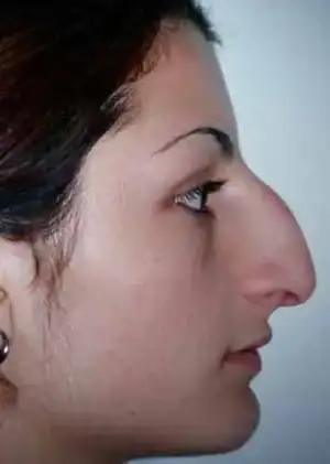 $rhinoplasty-67.webp