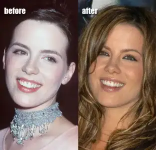 $kate-b-nose-teeth.webp