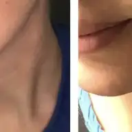 Yuz Germe Ameliyati Yaptirdim Cok Mutlu Oldum Kadinlar Kulubu