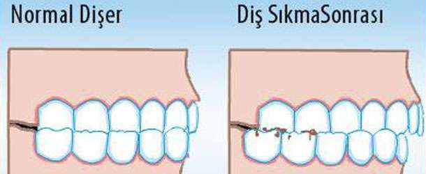 Diş gıcırdatmanın sebepleri nelerdir?