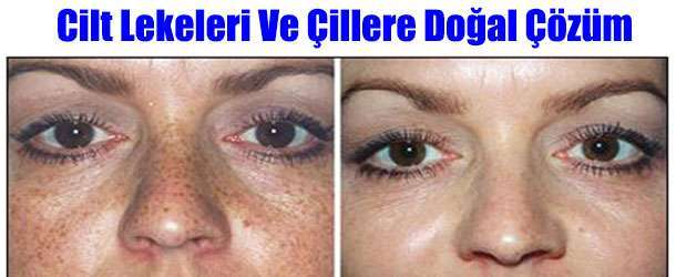 Cilt Lekeleri Ve Çiller İçin Maske