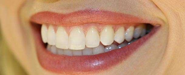 6 Adımda Diş Estetiği Nedir?