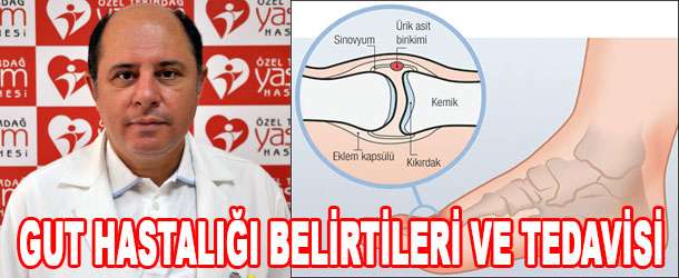 Gut Hastalığı Bitkisel Tedavisi | 1