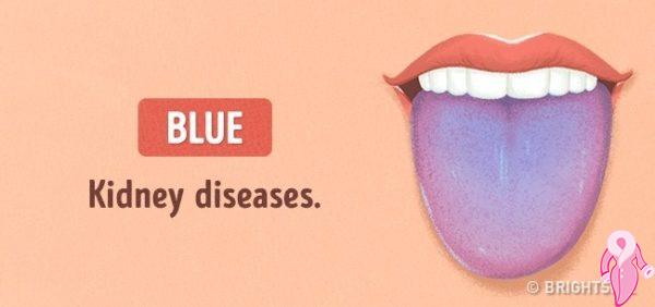 Dil Renginden Hastalık Analizi | 18