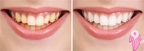 Diş Etinde Renk Değişikliği Neden Olur? | 1