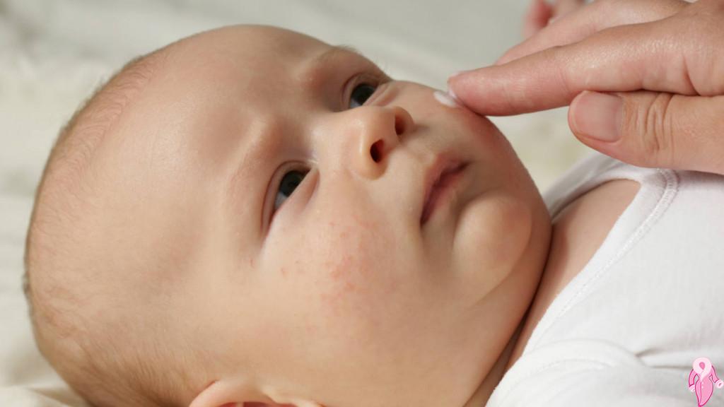 Bebeklerde Cilt Sorunları Nasıl Aşılmalıdır?