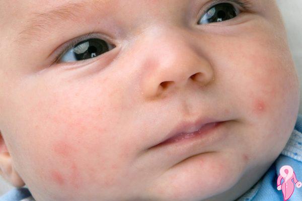 Bebeklerde Cilt Sorunları ve Vitamin Eksikliği | 1