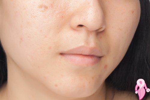 Evde Doğal Maske Yapımı: Karbonatla Maske Tarifi | 6