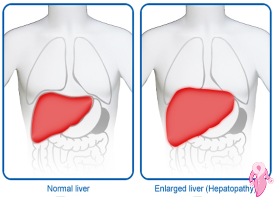 Grade 1 Hepatosteatoz Nedenleri, Belirtileri Ve Tedavi Yöntemleri | 2