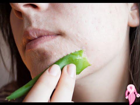 Sivilceler İçin Aloe Vera Nasıl Kullanılır? | 3