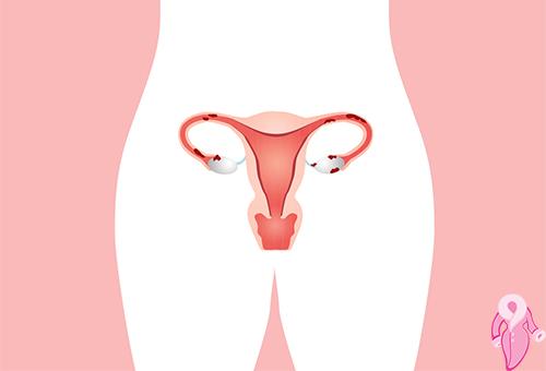 Çikolata Kisti Nedir? Endometriozis Neden ve Nasıl Oluşmaktadır? | 10