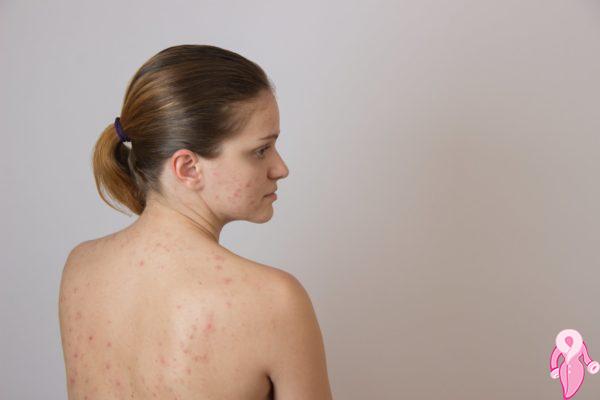 Hamlelikte Sivilce İçin Maske Tarifi | 2