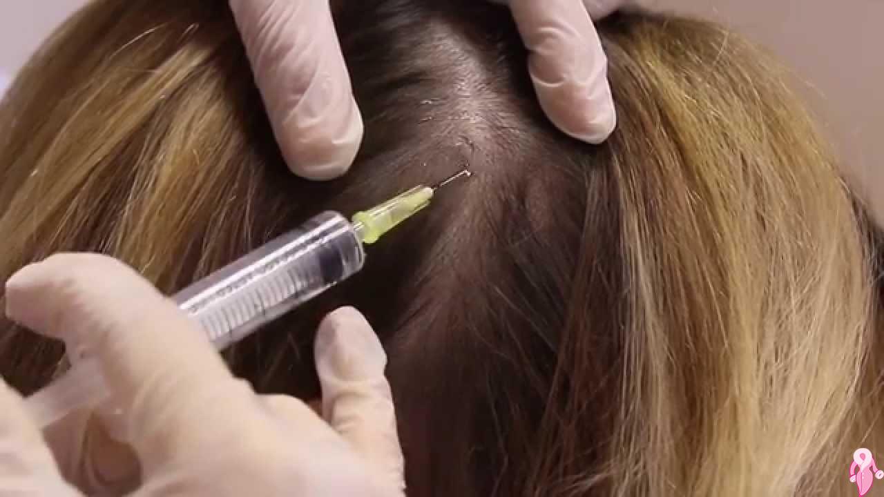 Saç Mezoterapisi Ne İşe Yarar? Saçlara Sağladığı Faydalar Nelerdir?