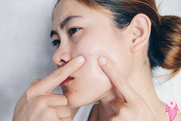 Kistik Sivilce İzleri Nasıl Geçer? Maske Tarifleri | 13