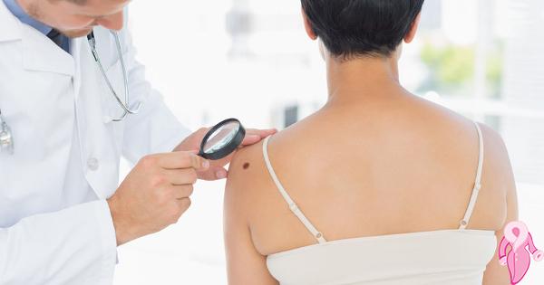 Malign Melanoma Nedir, Belirtileri, Evreleri Nelerdir?