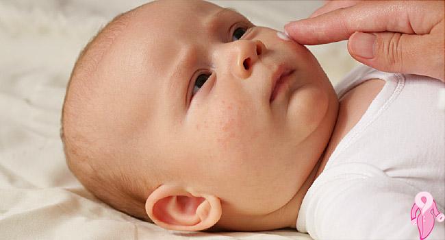 Bebeklerde Alerjik Egzama Nedir, Nasıl Geçer?