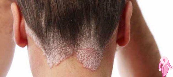 Seboreik Dermatit Doğal Tedavisi Ve Bitkisel Çözümler | 5