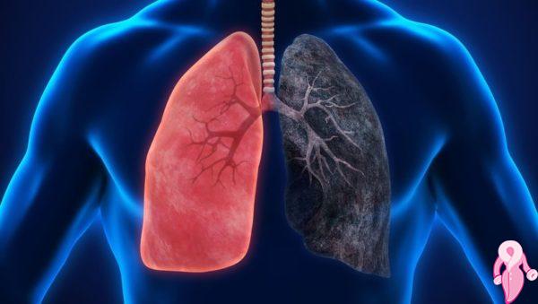 Akciğer Kanserinin İlk Belirtileri Nelerdir, Nasıl Anlaşılır?