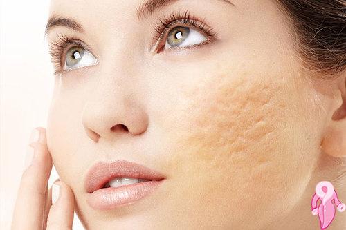 Natural Remedy for Pimples