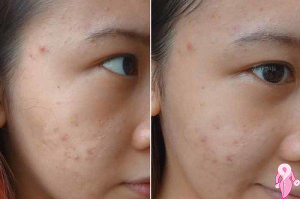 Natural Remedy for Pimples