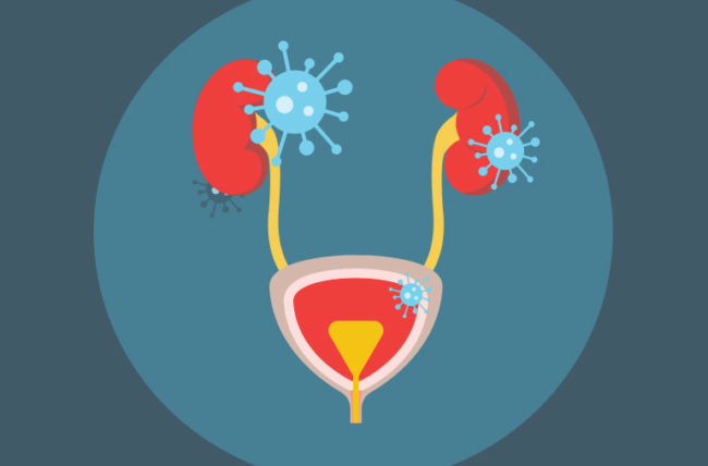 İdrar Yolu Enfeksiyonu Belirtileri Nelerdir? Tedavisi Nasıl Yapılır?