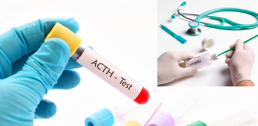 ACTH Nedir Normal Değerleri Kaç Olmalıdır?