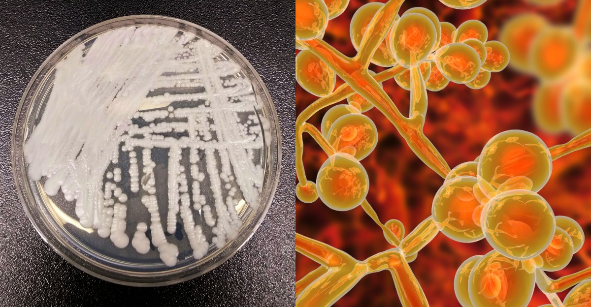 Candida auris: Nedir, Belirtileri ve Tedavisi