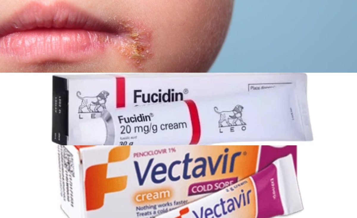 Uçuklara Veda Etmek İçin: 2024 Yılının En İyi 5 Uçuk Kremi Tavsiyesi