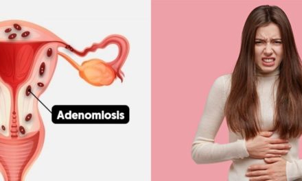Adenomiyoz ve endometriozisin IVF/ICSI üzerindeki etkisi