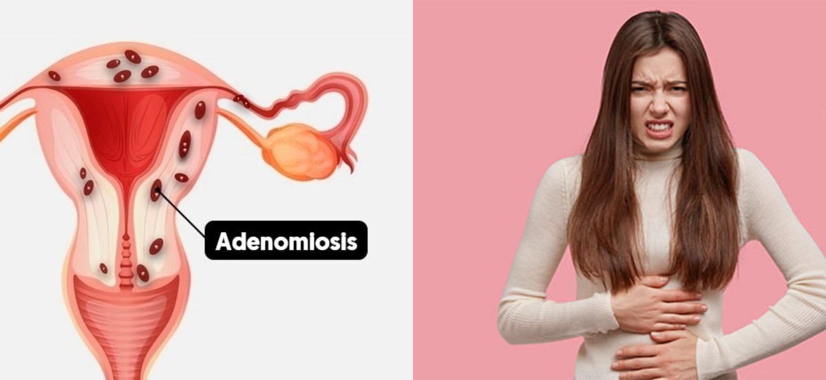 Adenomiyoz ve endometriozisin IVF/ICSI üzerindeki etkisi