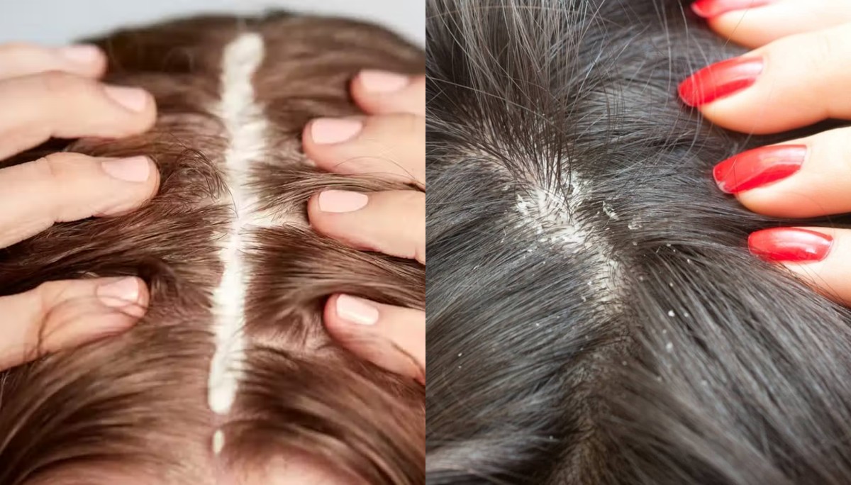 Kuru Saç Derisi: Dermatologlara Göre Nedenleri ve Nasıl Tedavi Edilir?