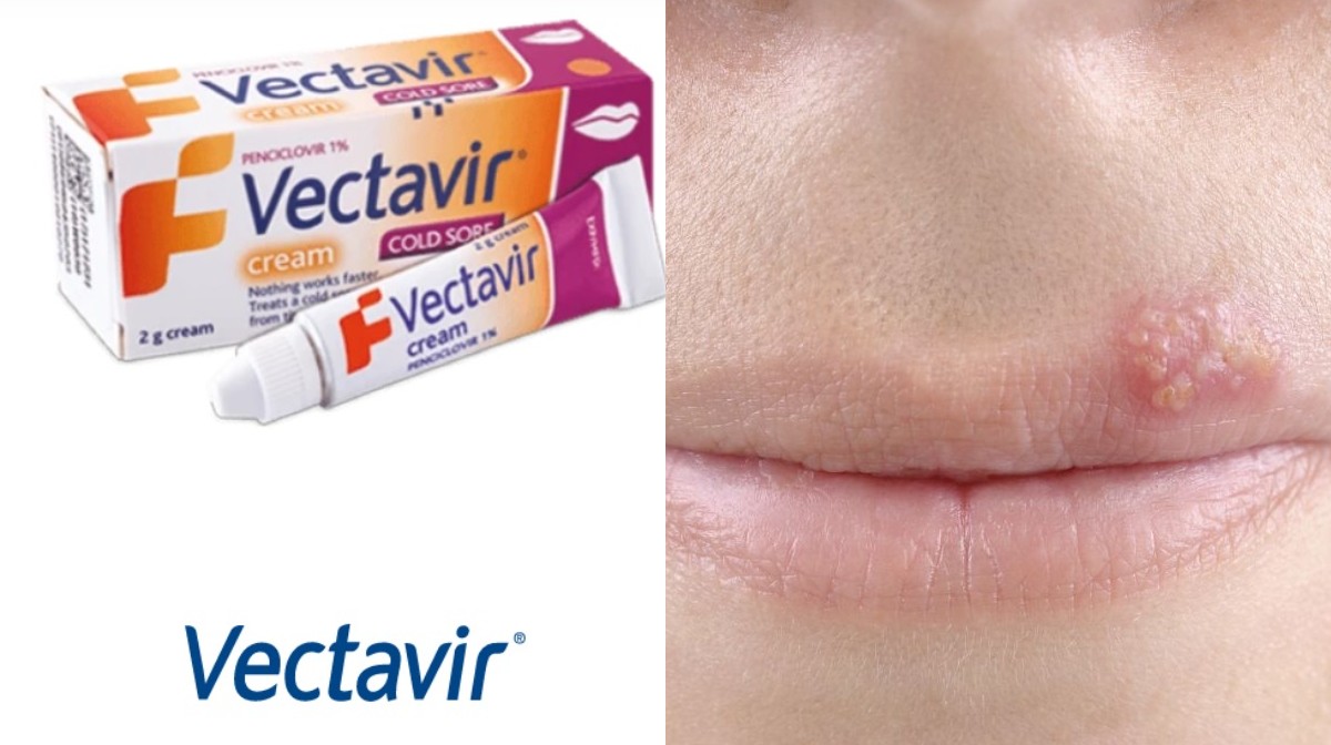 Vectavir Uçuk Kremi: Uçukların Tedavisinde Etkili Bir Çözüm