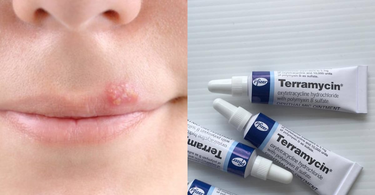 Terramycin (Teramisin) Krem Nedir? Uçuğa Sürülür Mü?