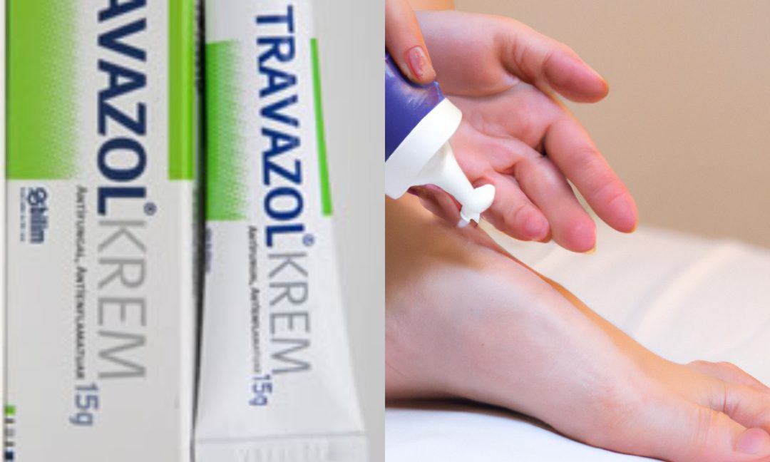 Travazol Krem Nedir? Uçuk Için Kullanılır Mı? - Kadınlar Kulübü