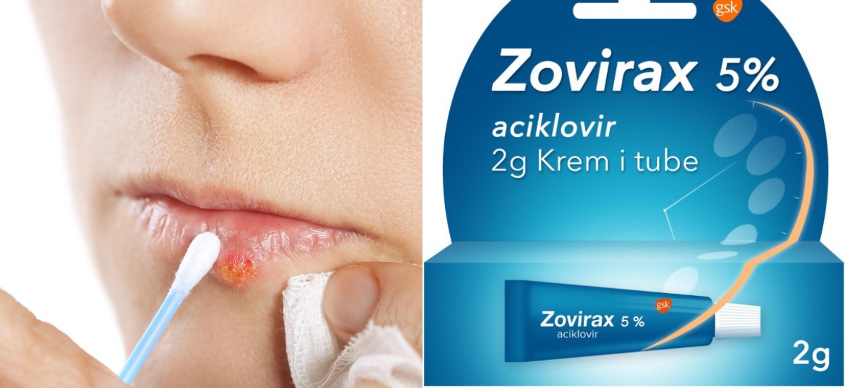 Zovirax Krem: Uçuk Problemlerine Hızlı ve Etkili Çözüm