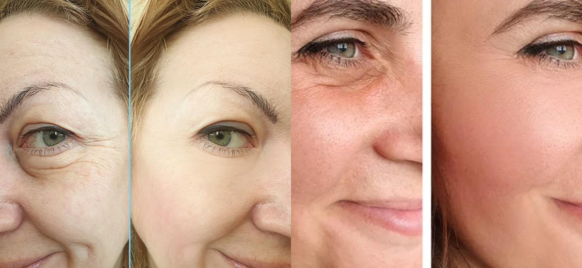 Facelift nedir? 5 adımda nasıl yapılır? Faydaları