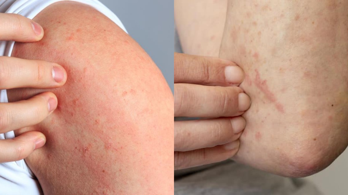 eczanede satilan en etkili uyuz ilacı