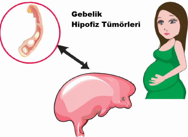 Gebelik ve Hipofiz Tümörleri