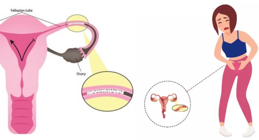 Fallop Tüpü Tıkanıklığı Nedir? Nasıl Açılır? 5 Belirtisi