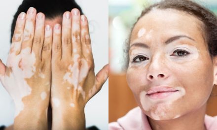 Vitiligo: Cildin Renk Değişimine Karşı Bir Mücadele