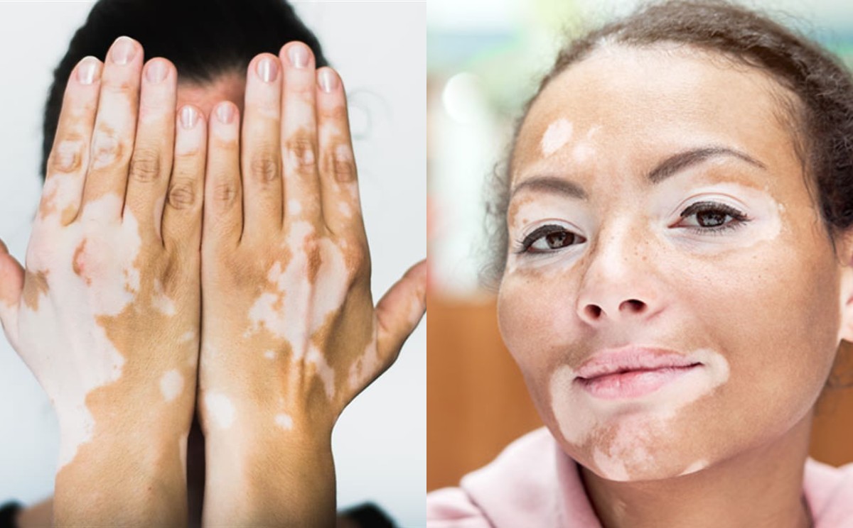 Vitiligo: Cildin Renk Değişimine Karşı Bir Mücadele