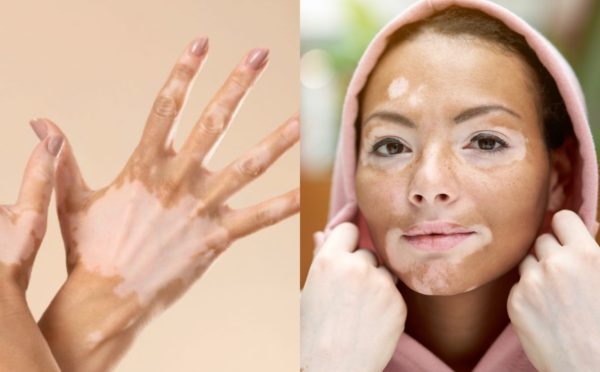 Vitiligo: Cildin Renk Değişimine Karşı Bir Mücadele